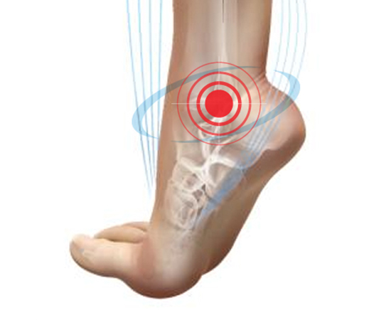 Over pronation and supination